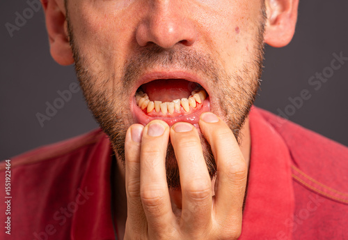 Man showing inflamed, bleeding gums as a symptom of periodontitis, poor oral hygiene and dental care