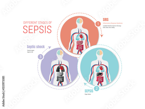 Different stages of sepsis explained with human body anatomy