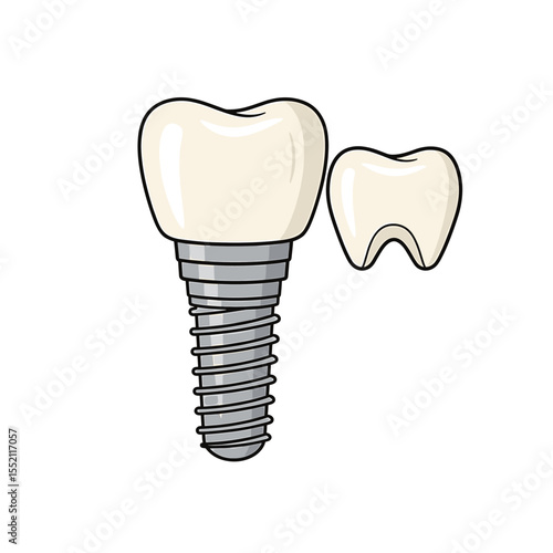 Dental implant illustration, showing a tooth implant and a natural tooth.
