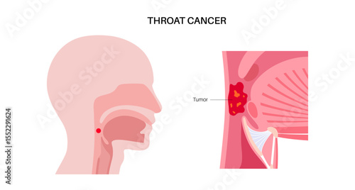 Throat cancer poster