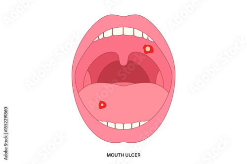 Mouth ulcer poster