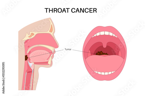 Throat cancer poster