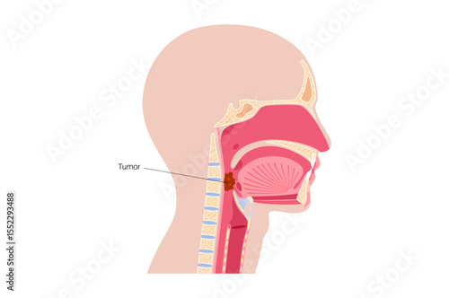 Throat cancer poster