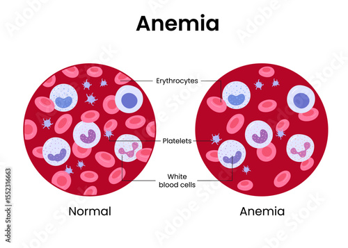 Vector illustration of the difference of number of healthy red blood cells. Anemia and normal.	
