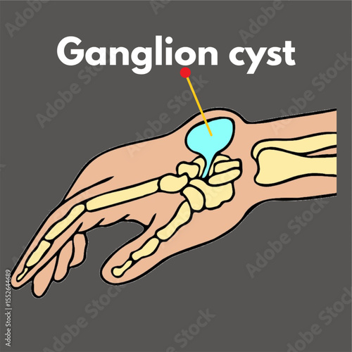 ganglion cyst on above of wrist illustration  science disease fluid filled cyst.eps