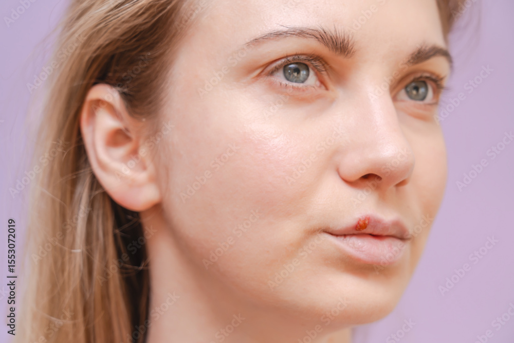 Fototapeta premium Closeup of young woman with herpes cold sore on mouth against purple background. Herpes blisters