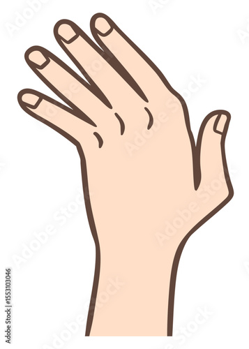 関節リウマチ、手指尺側偏位