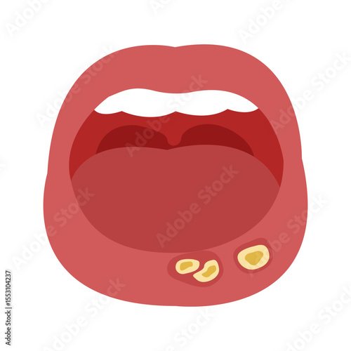 canker sore in mouth. vector illustration
