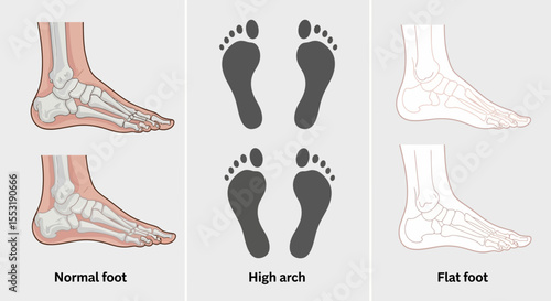 Anatomical Illustration of Normal, High-Arch, and Flat Feet with Footprints