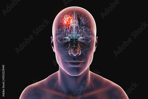 Brain tumor, 3D illustration. Meningioma, glioma, astrocytoma, and other brain tumors