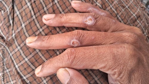 injured and peeled fingers on a brown skin man hand
