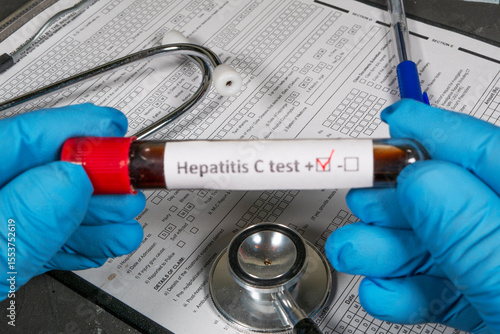 Doctor holding blood sample with positive hepatitis c test result