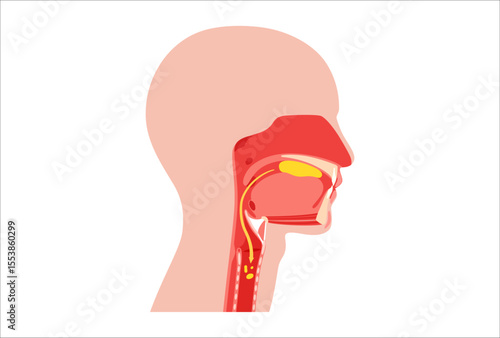 Aspiration pneumonia infection