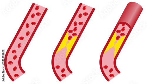 Blood vessel with atherosclerosis and red blood cells