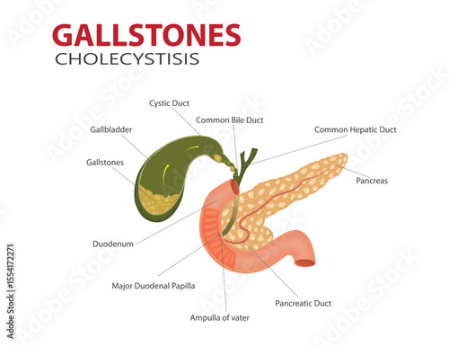 Medical Illustration of Gallstones and Cholecystitis in the Gallbladder with Labelled Digestive System Anatomy. Medical diagram showing gallstones and cholecystitis.

