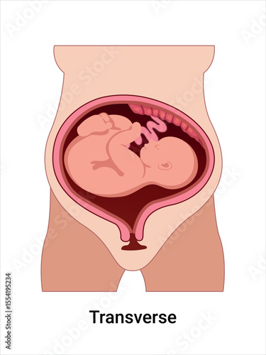 Transverse baby positions in the uterus during pregnancy. Pathology. Detailed medical vector illustration. Fetus with umbilical cord, placenta.
