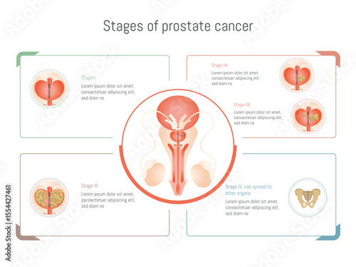 Prostate cancer stages infographic showing tumor growth