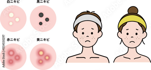 思春期の男女のニキビ