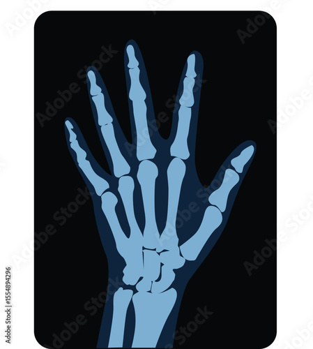 Osteoarthritis image. x ray image of the hand