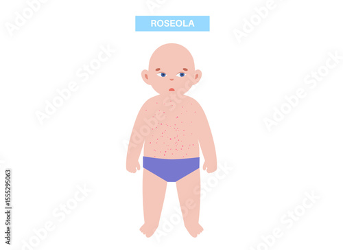 Roseola or exanthem subitum