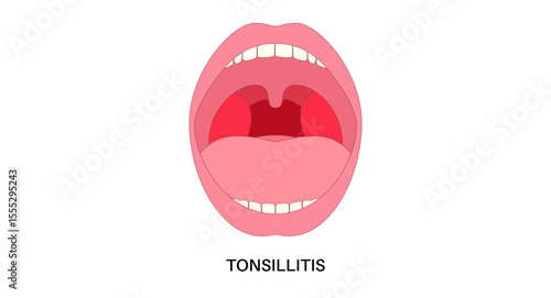 Tonsillitis Oral Desease
