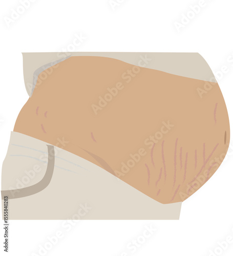 stretch marks on pregnant women's stomachs