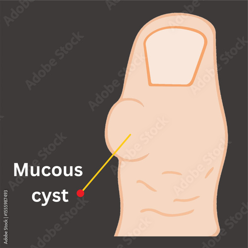 thumb finger with cyst filled with mucous disease.eps