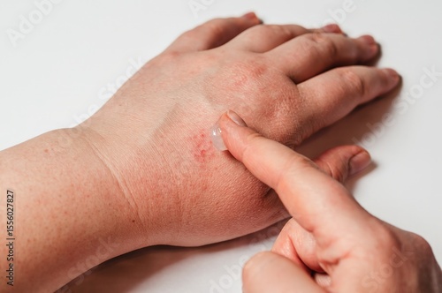 Φωτογραφία A person applies cream to irritated skin on their hand, indicative of a skin condition