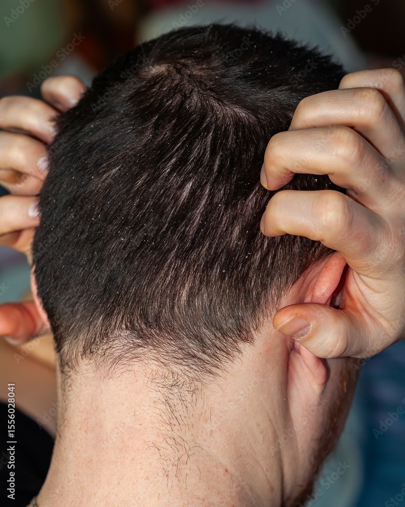 Fototapeta premium Close-up view of dark hair affected by dandruff, highlighting a common scalp issue.