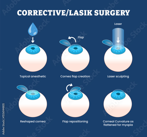 Corrective Laser Eye Surgery or Lasik Surgery Procedure Progress for Educational Medical Poster Design Healthcare Scheme, Labeled Laser-Assisted In Situ Keratomileusis for Reshape Cornea.