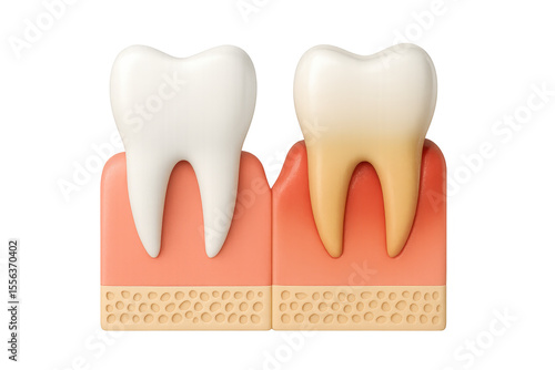 Healthy gums versus inflamed gums shown with two teeth and gums. Transparent