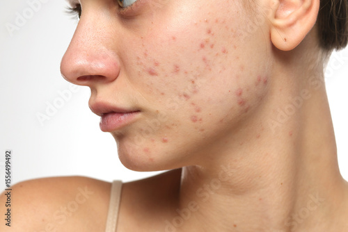 Studio closeup of young woman with acne on cheek and jawline, skincare concept, white background.
