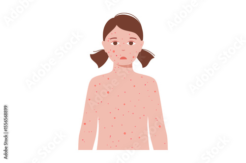 Varicella medical poster