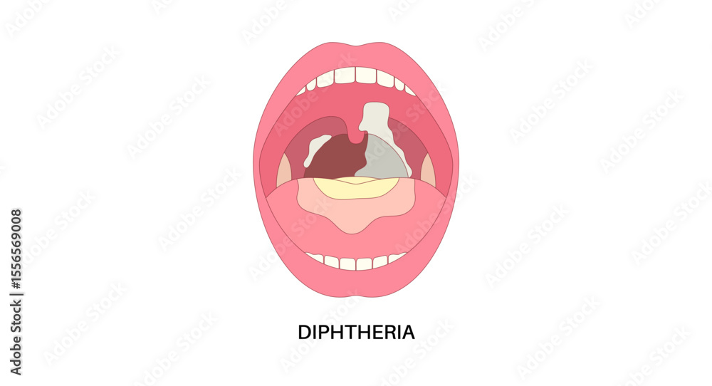 Foto diphtheria oral disease
