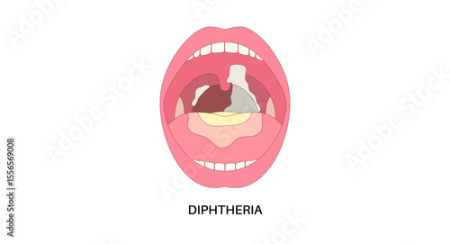 diphtheria oral disease