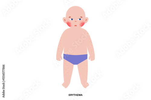 Fifth disease or erythema infectiosum