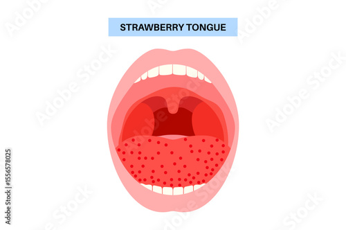 Strawberry tongue poster