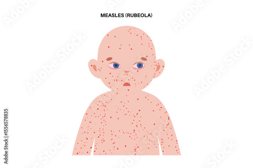 Measles or rubeola symptoms.