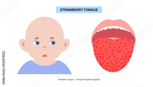 Strawberry tongue poster