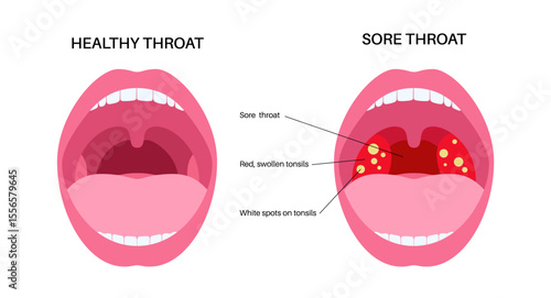 Sore throat poster