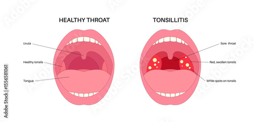 Tonsillitis Oral Desease