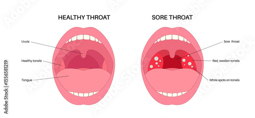 Sore throat poster