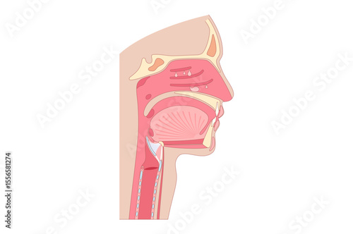 Nasal Polyps poster