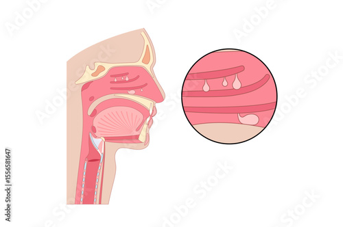 Nasal Polyps poster
