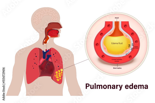 Pulmonary edema. Lung diseases anatomy. Human respiratory system.