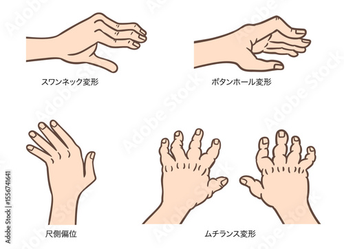 関節リウマチによる手指変形：スワンネック、ボタンホール、尺側偏位、ムチランス変形