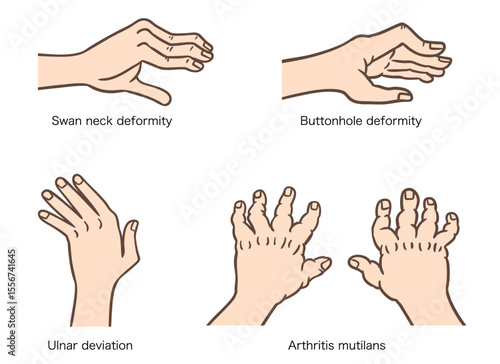 関節リウマチによる手指変形：スワンネック、ボタンホール、尺側偏位、ムチランス変形