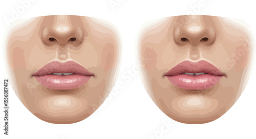 Illustration showcasing before and after lip augmentation procedure with filler injection