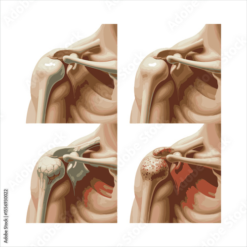 Illustration of the progression of shoulder osteoarthritis showing healthy and damaged joints