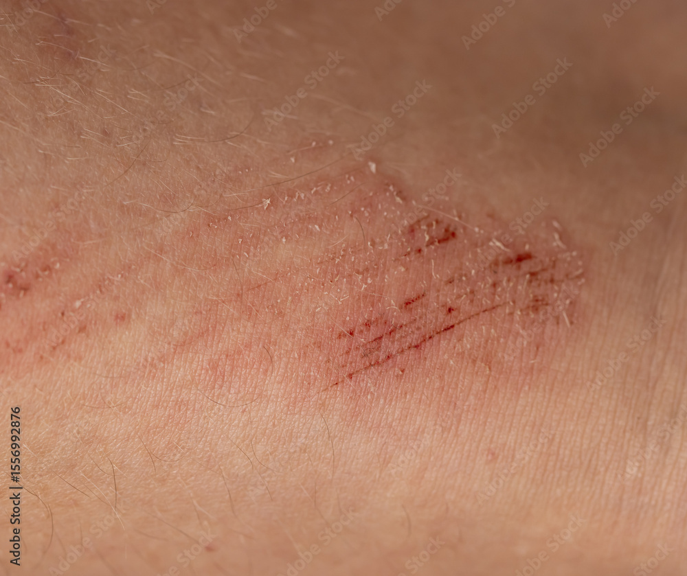 Fototapeta premium A person's arm has a red mark on it